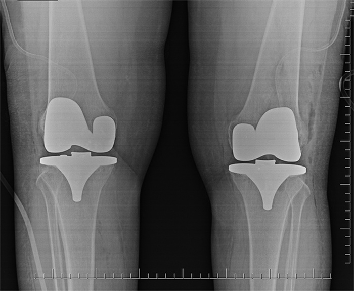 TOTAL KNEE REPLACEMENT