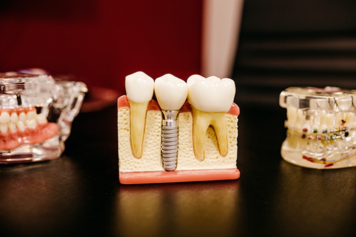 IMPLANT