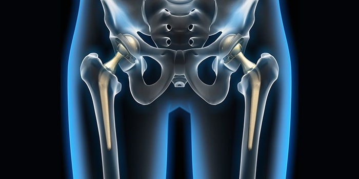 TOTAL HIP REPLACEMENT