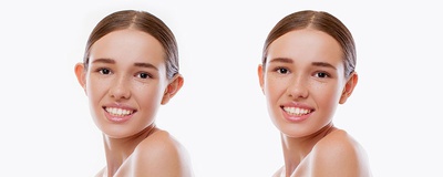 AESTHETIC EAR SURGERY(OTOPLASTY)