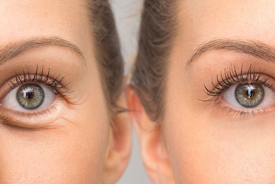 AESTHETIC EYELIED SURGERY(BLEPHAROPLASTY)