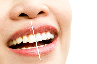 TEETH WHITENING (BLEACHING)
