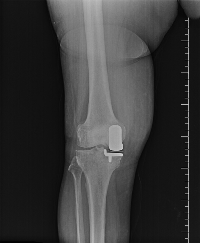 UNICOMPARTMENTAL KNEE REPLACEMENT